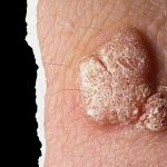 Papiloma Vírus Humano: Saiba mais sobre o HPV