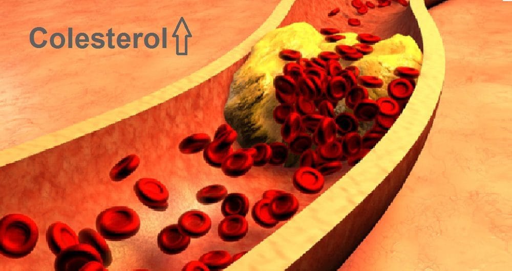 Novo medicamento para Tratamento do colesterol em pacientes HIV