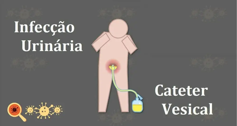 Infecção urinária associada a sonda vesical