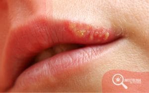 Como Evitar as Crises de Herpes Simples