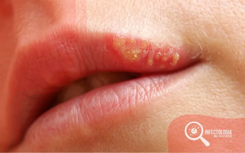 Como Evitar as Crises de Herpes Simples
