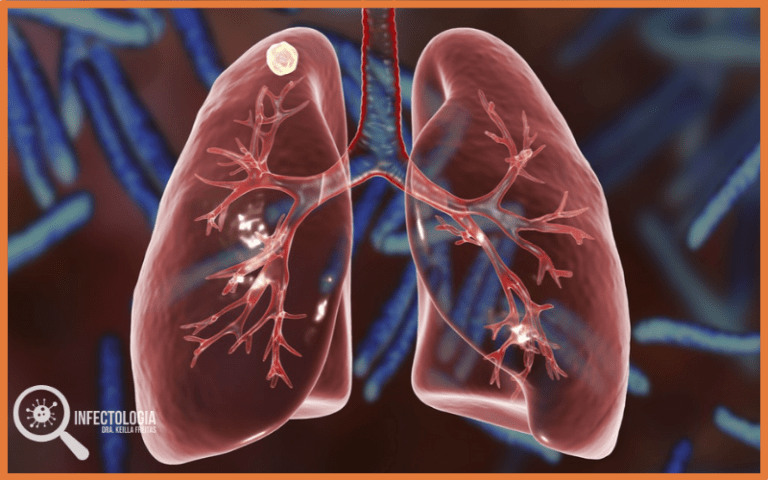 Conheça Os Tipos De Tuberculose Extrapulmonar Dra Keilla Freitas