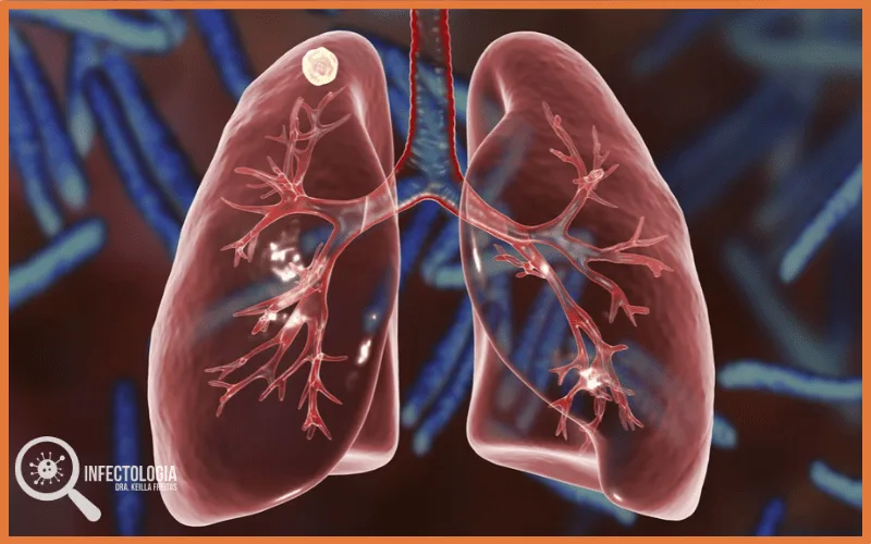 Tuberculose: Saiba mais