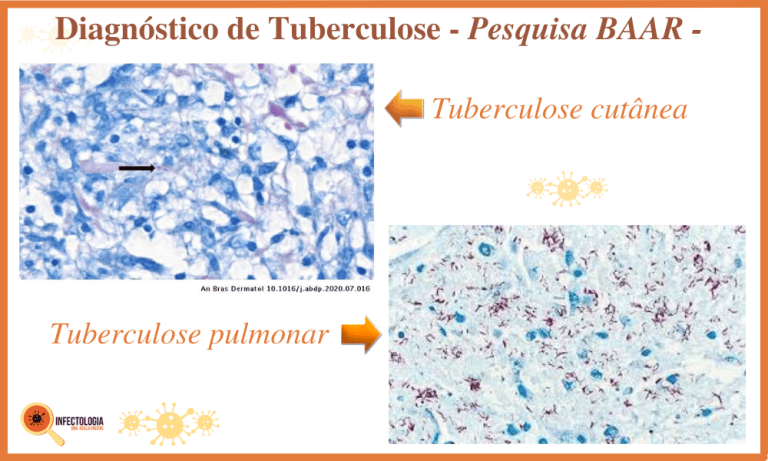 Diagnóstico Da Tuberculose