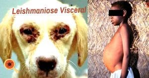 Leishmaniose Visceral