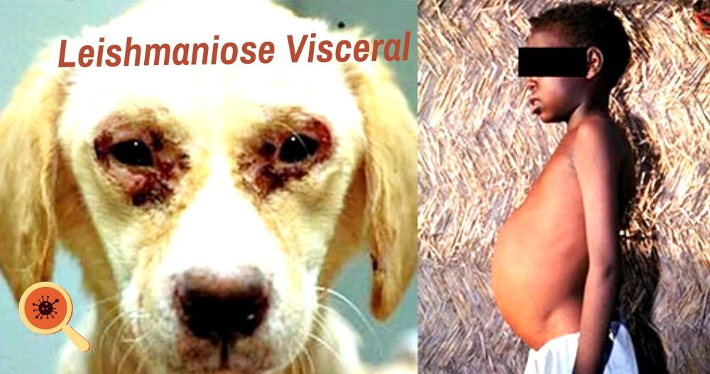 Leishmaniose Visceral
