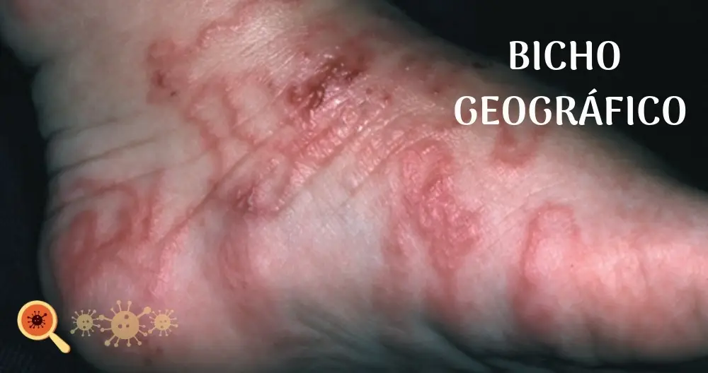 Bicho geográfico ou Larva migrans cutânea