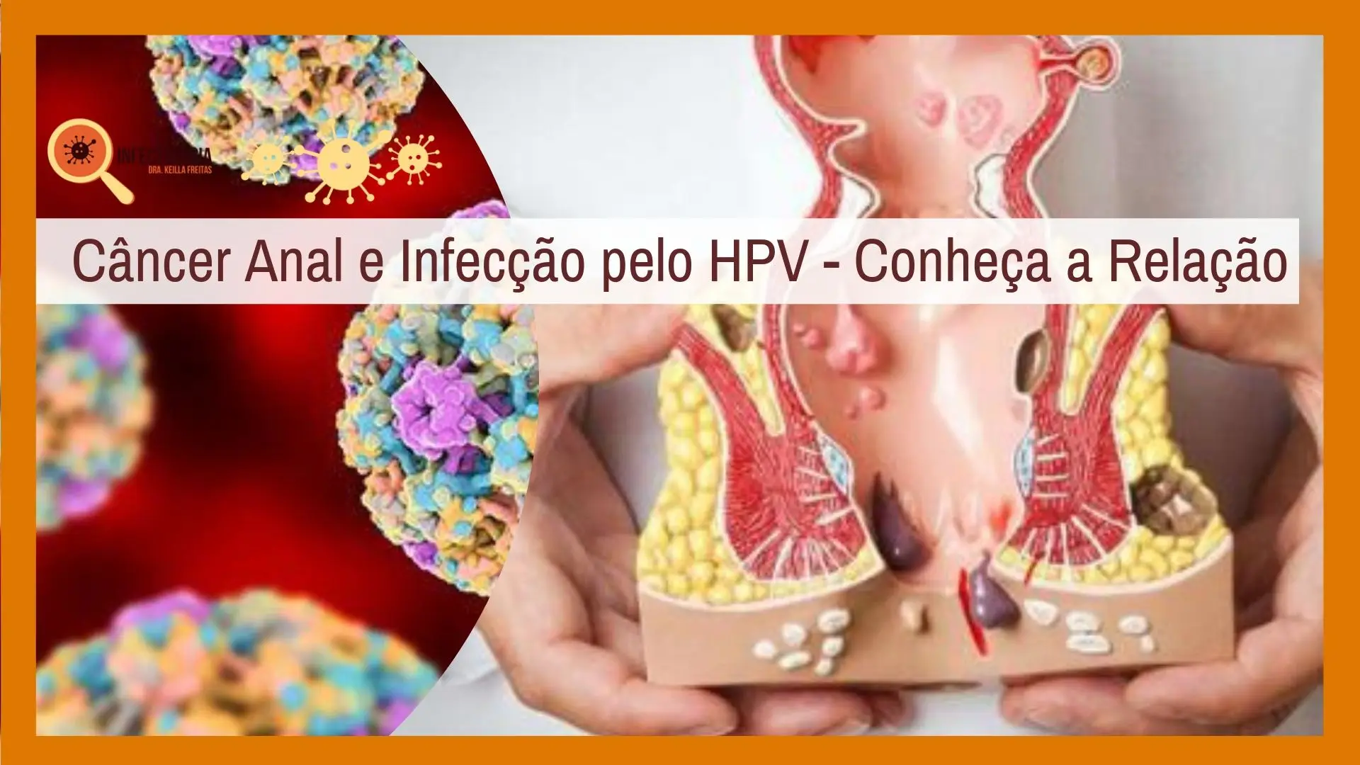Câncer Anal e Infecção pelo HPV