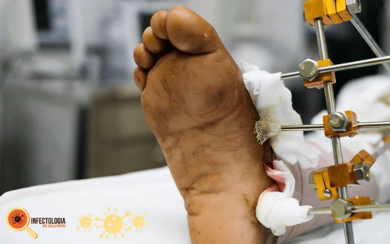 Osteomielite: Saiba Mais Sobre esta Infecção