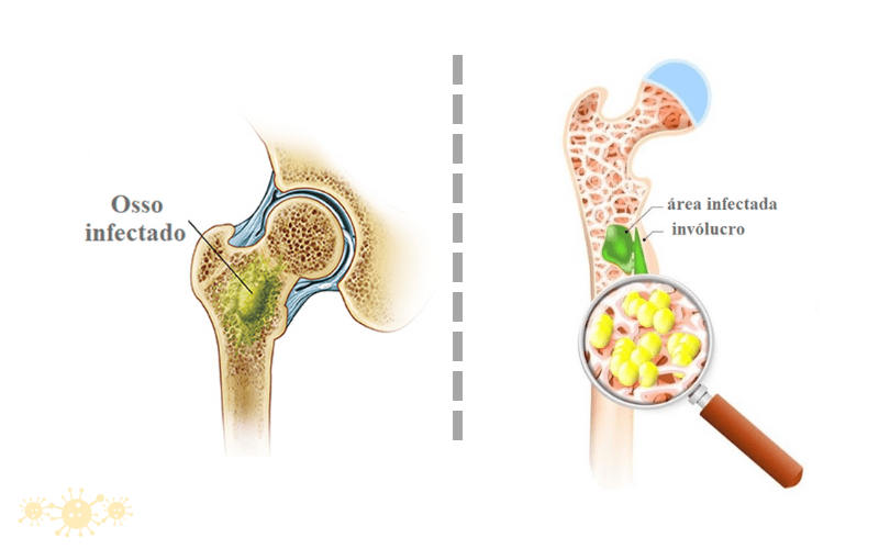 Osteomielite: Saiba Mais Sobre Ela - Dra. Keilla Freitas Infectologista