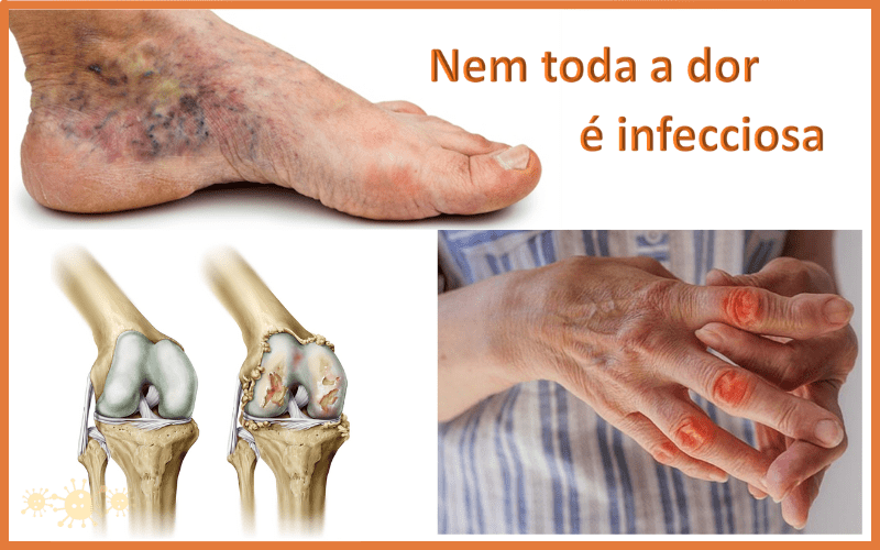 Osteomielite: Saiba Mais Sobre Ela - Dra. Keilla Freitas Infectologista