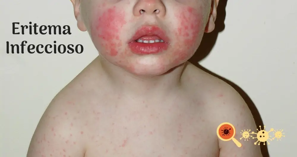 Eritema Infeccioso