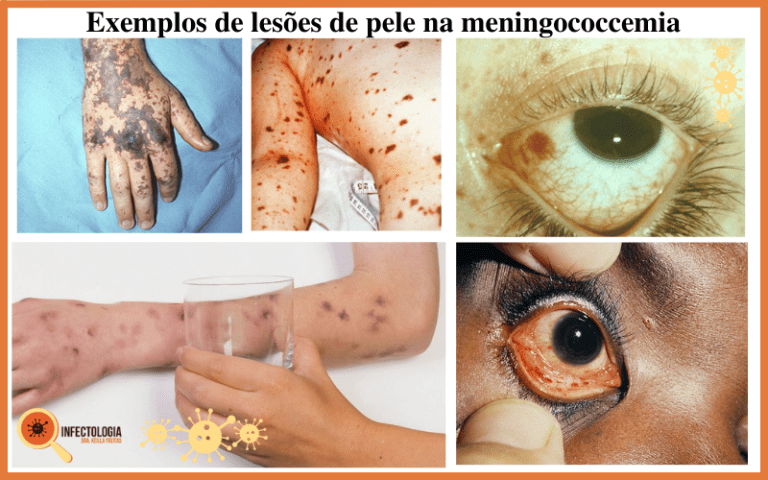 Infecção Meningocócica Saiba Mais Dra Keilla Freitas 1473