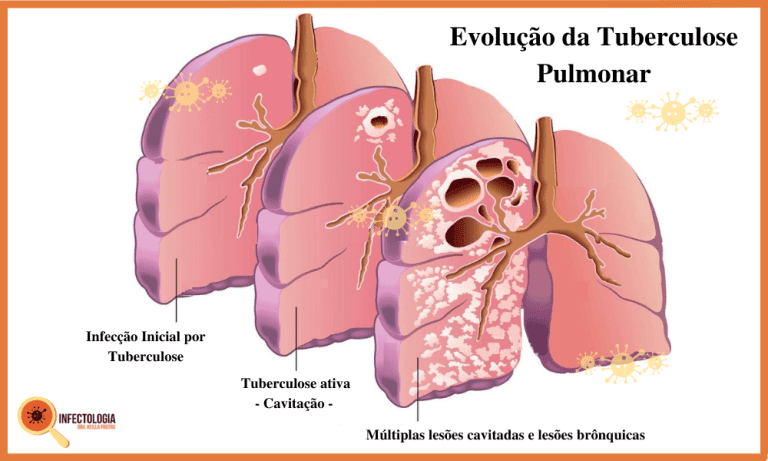 Tuberculose Saiba Mais Dra Keilla Freitas Infectologista Em Moema