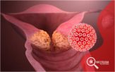 Papiloma Vírus Humano: Saiba mais sobre o HPV