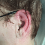 Como Tratar Infecções de Ouvido em Adultos