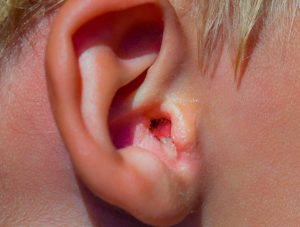 Como Tratar Infecções de Ouvido em Adultos