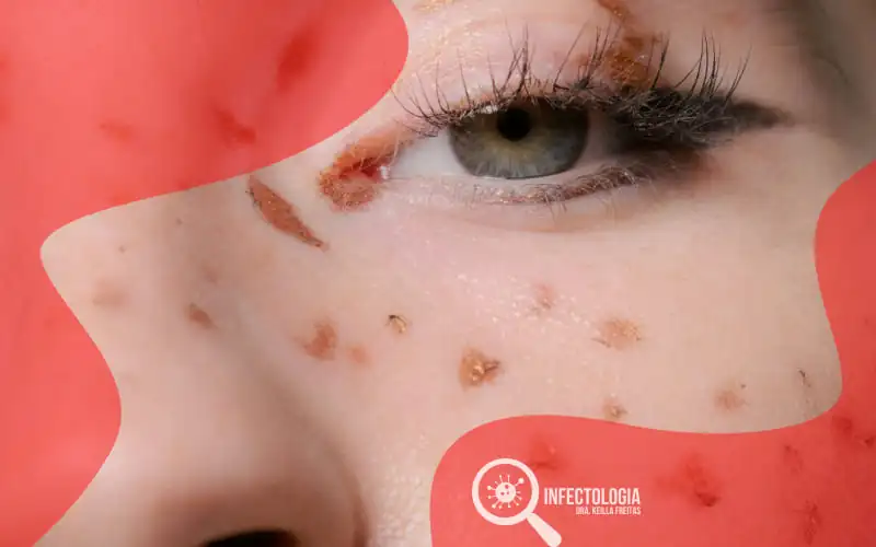 Criptococose em Pessoas com HIV
